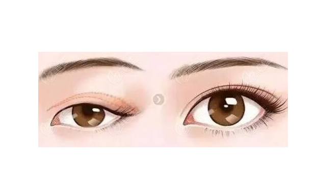 徐州二院哪個(gè)醫(yī)生做雙眼皮好？陶常波、張愛君等實(shí)力過(guò)硬