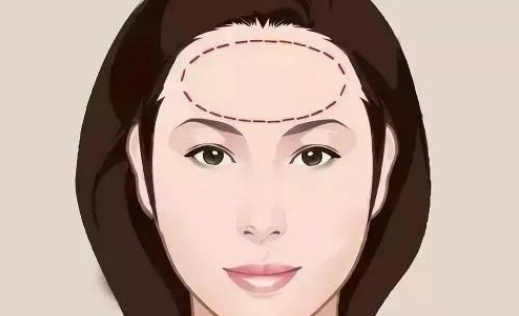 喬雅登雅致適合做哪些部位？皺紋拜拜|玻尿酸去抬頭紋案例附上