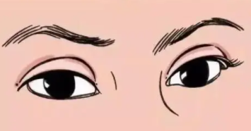 雙眼皮1.png 雙眼皮1.png