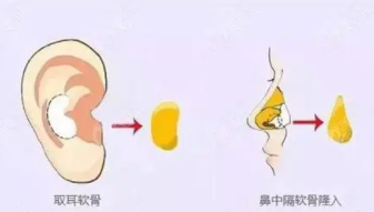 隆鼻12.png 隆鼻12.png