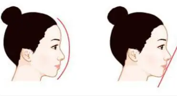 隆鼻9.png 隆鼻9.png