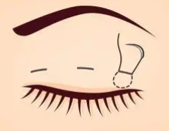 雙眼皮17.png 雙眼皮17.png